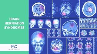 Brain Under Pressure: Recognizing the Signs of Brain Herniation Syndromes - @mdmedicine.network