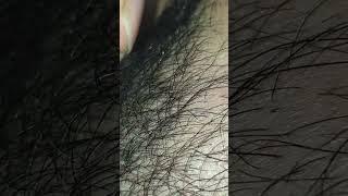 #ingrownhair #satisfying #hair #remove #asmr #hairstyle #trending #oddlysatisfying #waxing