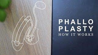 How Phalloplasty Works | FTM Transgender