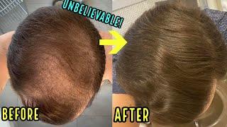 HE REGREW HIS BALD HEAD USING THESE 3 SIMPLE HAIR LOSS TREATMENTS!