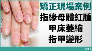 Correction cases｜Redness and swelling of the matrix of the fingernails Shrinkage of the nail bed