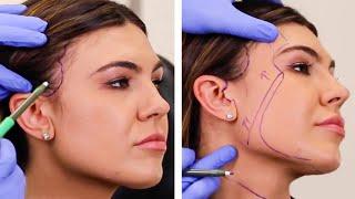 Where are the facial incisions for a facelift? Incisions for Vertical Restore™ Facelift