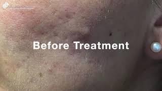 Emergency Spot Treatment | Lumiere Clinic Manchester | Skin & Aesthetics