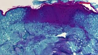 WHO quan ngại về virus đậu mùa khỉ