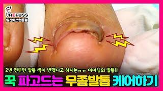 파고드는 발톱이 심지어 변색된발톱이다! 발톱 색이 2년전부터 바뀌었어요ㅠㅠ #레푸스 #레푸스일산 #파고드는발톱 #문제성발톱 #ingrown_toenail #refuss