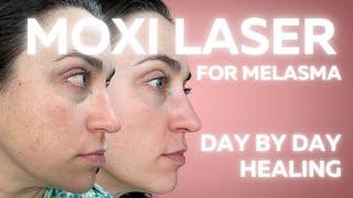 MOXI LASER FOR MELASMA: DAY BY DAY HEALING