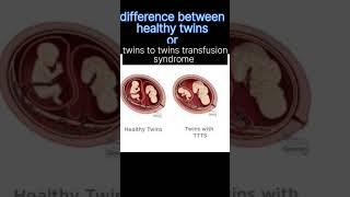 #TTTS#twin_twin_transfusion_syndrome #shortsvideo #twinsbabies #twins #babydevelopment #babyinwomb