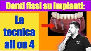 La guida definitiva: Denti fissi su 4 impianti ( all on four )