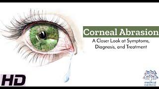 Corneal Abrasion: A Closer Look