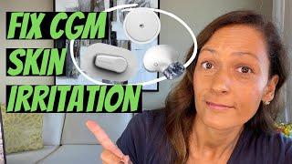 How to prevent skin irritation from CGM adhesive