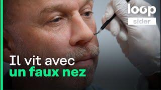 « Je ne pensais pas qu'on pouvait avoir un cancer du nez », Michel raconte sa vie sans nez