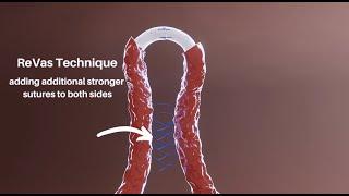 Vasectomy Reversal: REinforcing VAsal Suture (ReVas Technique)