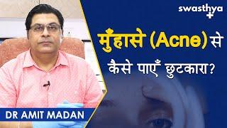 मुंहासे से कैसे पाएं छुटकारा? | Cause of Pimple in Hindi | Dr Amit Madan | Pimples को कैसे रोके?