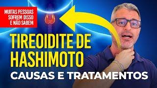 Tireoidite de Hashimoto: Sintomas, Causas e Tratamentos