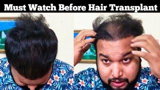 Reality Of Hair Transplant After 3 Years || Best Hair Transplant 2021 || Sourav Mridha