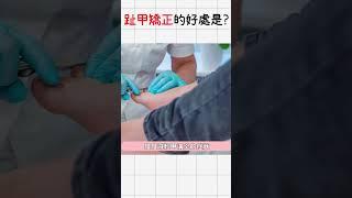 不用拔指甲指甲矯正🩵舒適治療戴矯正器就好‼️__皮膚專科 | 劉奎蘭醫師 #凍甲 #灰指甲 #指甲 #指甲矯正 #皮膚科  #shorts ️【來訊預約】