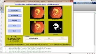 Matlab Project for Glaucoma Detection Using Image Processing Full Source Code