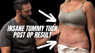 Mommy Makeover Tummy Tuck Post-operative Result