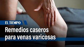 Remedios caseros para venas varicosas: Alivia el dolor y la hinchazón en casa | El Tiempo