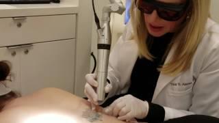 Laser Tattoo Removal - How To Remove a Tattoo with Picoway  | Washington DC