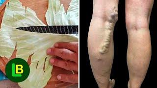 Amazing! Get rid of varicose veins. Just put these leaves over and wait