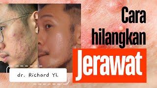 Cara gampang menghilangkan jerawat