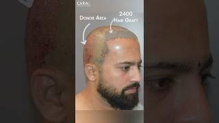 2400 Grafts Later: A Hair Restoration Success Story