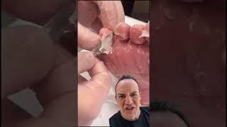 DOCTOR REACTS: DON’T PEEL SKIN OFF YOUR FEET!#shorts