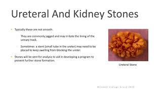 Ureteroscopy for Ureteral and Kidney Stones