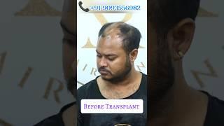 Hair Surgery in Kolkata, $ingle Days #hairtransplant