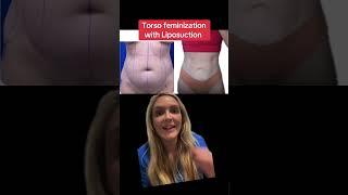 Torso Feminization with Lipo