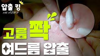 [압출킹] 48. 고름쫘악!!   화농성 여드름과  비화농성 여드름 압출 ASMR 시원함 주의!!..!!!