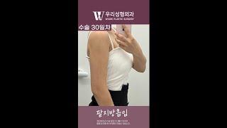 팔뚝지방흡입 리얼 한달차 후기  #shorts