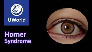 Horner Syndrome & Lateral Medullary (Wallenberg) Syndrome - extra high yield, USMLE UWorld Question