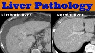 Abdomen Pathology