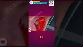 غشاء البكارة والعادة السرية فض غشاء البكارة عند الزواج لأي استفسار اكتب تعليق وبرد عليك