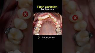How to fix crooked teeth #braces #orthodontist #dentist #dentistry