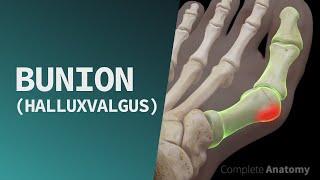 Bunion (Hallux Valgus)