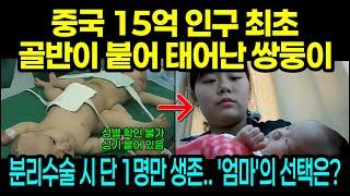 [실제사건] 골반이 붙어 태어난 최초의 쌍둥이