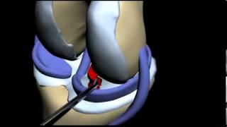 Мениск разрыв и операция