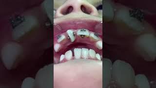 Orthodontist Reacts! INSANE Rotated Tooth! #Shorts