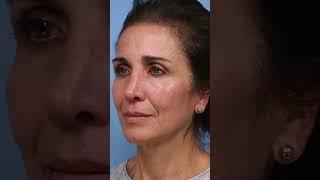 Facial Rejuvenation with Morpheus8 | Microneedling with Radio Frequency | Bay Area's Best Treatment