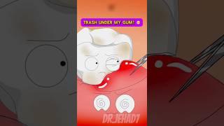 Food Stuck in My Gum?! (Impacted Tooth Animation) + Gum Pain Explained #wisdomteeth