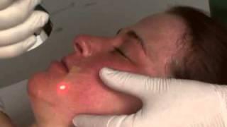 Micro Laser Peel (Skin Resurfacing) - Dr. Bitner