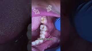 Dental Abscess!