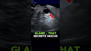 Nabothian Cyst in CERVIX  #ultrasound #uterus #cervical #mass #cyst