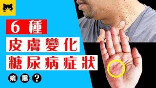 糖尿病症狀：6種出現在皮膚的糖尿病症狀 （皮膚癢 變黑 感染。。）