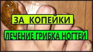 МОЩНЕЙШЕЕ  СРЕДСТВО от ГРИБКА НОГТЕЙ  ! Рецепт.