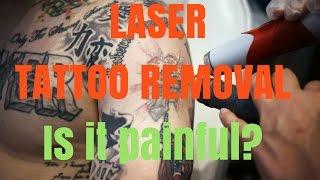 Laser Tattoo Removal- The truth.