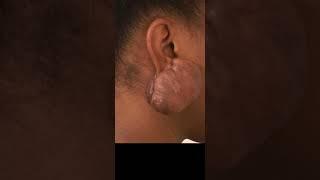 Massive Ear Keloid